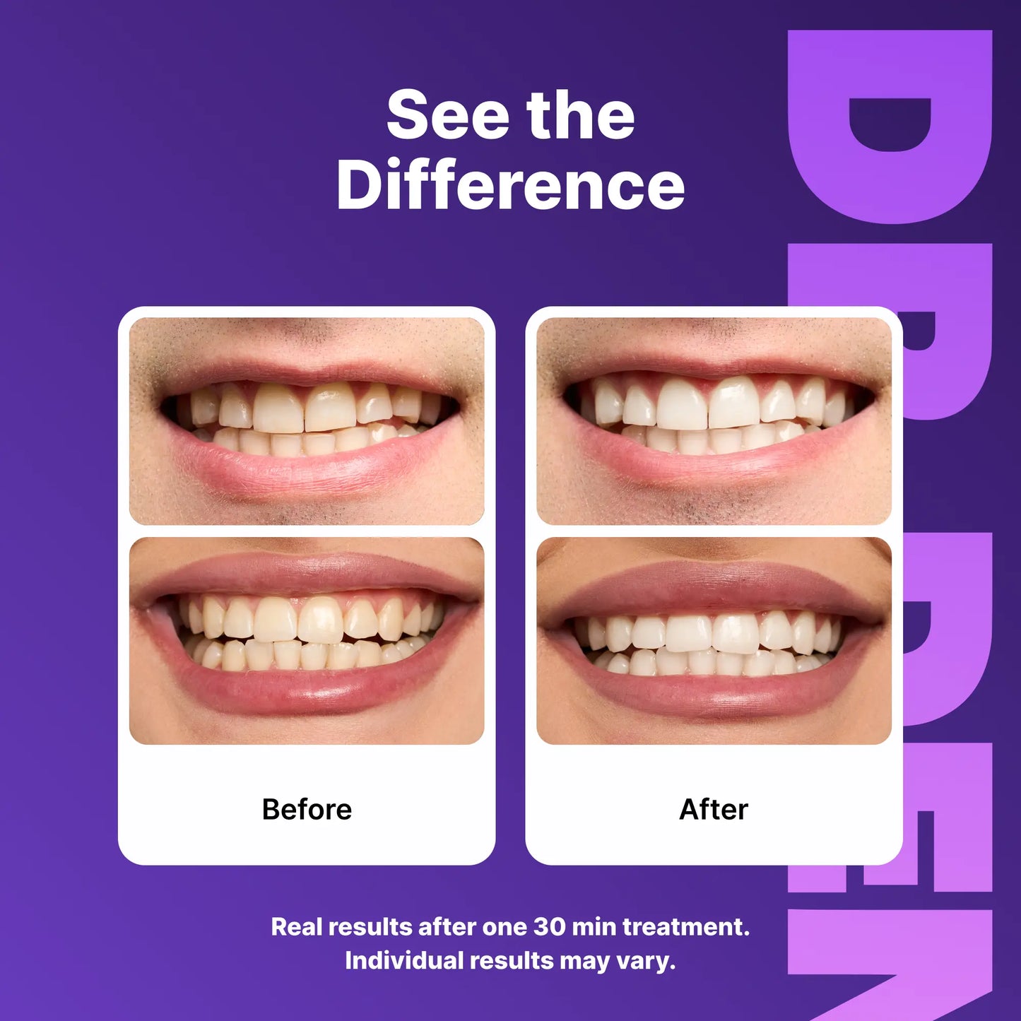 Transform Your Smile with DRDENT Enamel-Safe Purple Teeth Whitening Strips - 7/21 Sessions of Non-Sensitive, Peroxide-Free Brilliance